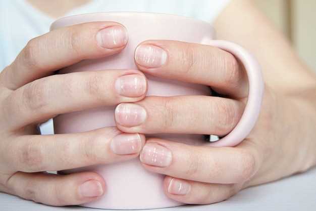 Причины слоения ногтей