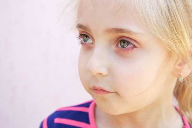 Способы удаления пятен под глазами у детей